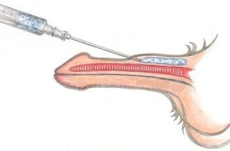Une méthode dangereuse d'agrandissement du pénis utilisant des injections de vaseline